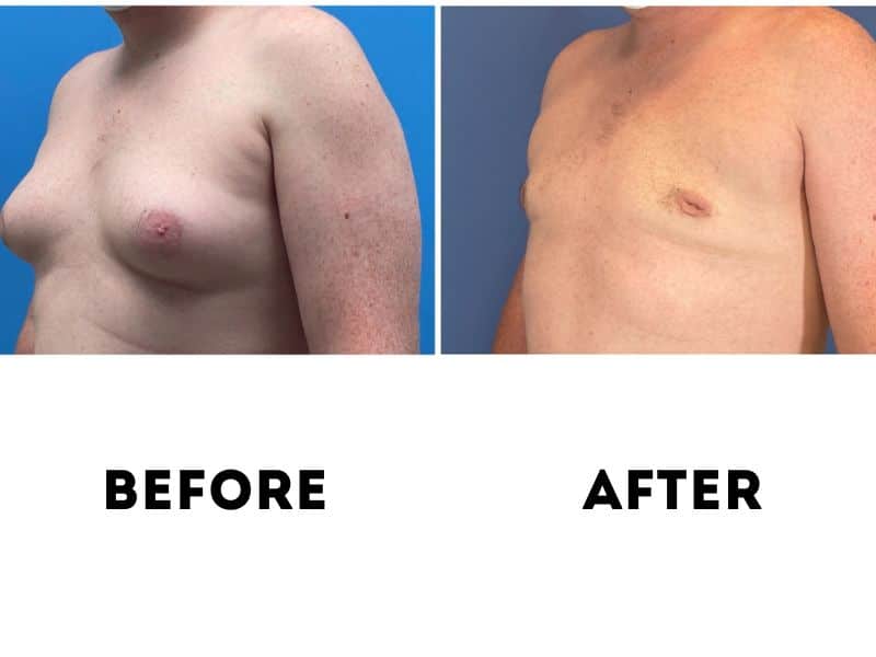 جراحی ژنیکوماستی (Gynecomastia Surgery)