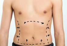 10 برترین انواع عمل زیبایی بدن در ایران و جهان+ عکس