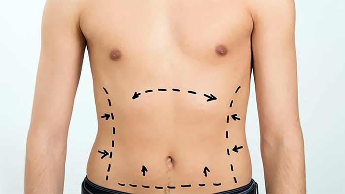 10 برترین انواع عمل زیبایی بدن در ایران و جهان+ عکس