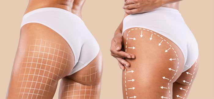 تزریق چربی به باسن (Fat Grafting to Buttocks)