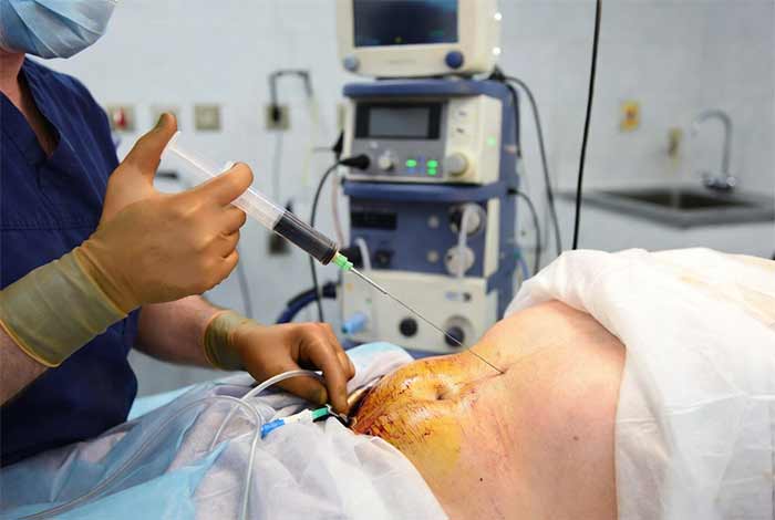 لیپوساکشن (Liposuction)
