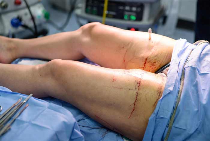 لیفت ران (Thigh Lift)