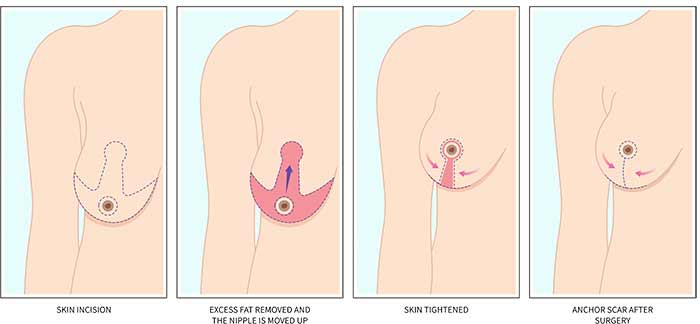 لیفت سینه (Breast Lift - Mastopexy)