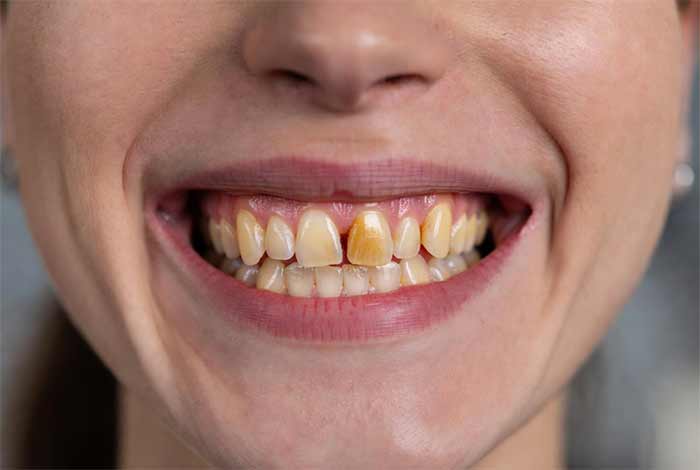 دندان‌های نامرتب، زرد یا با فاصله